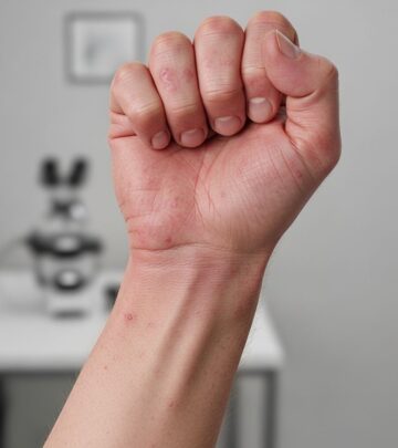 Understanding drug-induced dermatomyositis: causes, symptoms, diagnosis, and effective management strategies for this rare autoimmune condition.