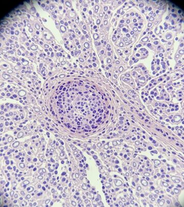 Comprehensive pathology overview of erythema elevatum diutinum, a rare chronic leukocytoclastic vasculitis affecting skin extensors.