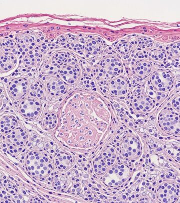 Detailed histopathological analysis of necrobiosis lipoidica, a granulomatous skin disorder linked to diabetes and collagen degeneration.