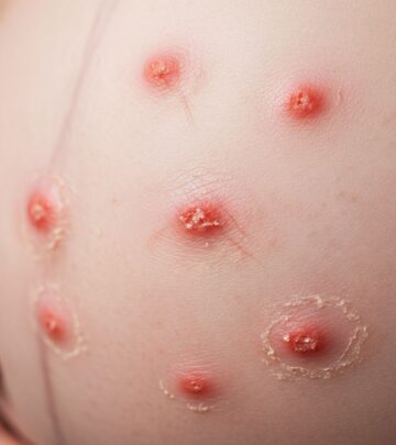 Explore detailed images and clinical insights into prurigo of pregnancy, a common itchy rash during gestation.