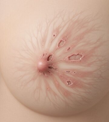 Understanding mammary Paget's disease: A rare breast cancer affecting the nipple and areola.